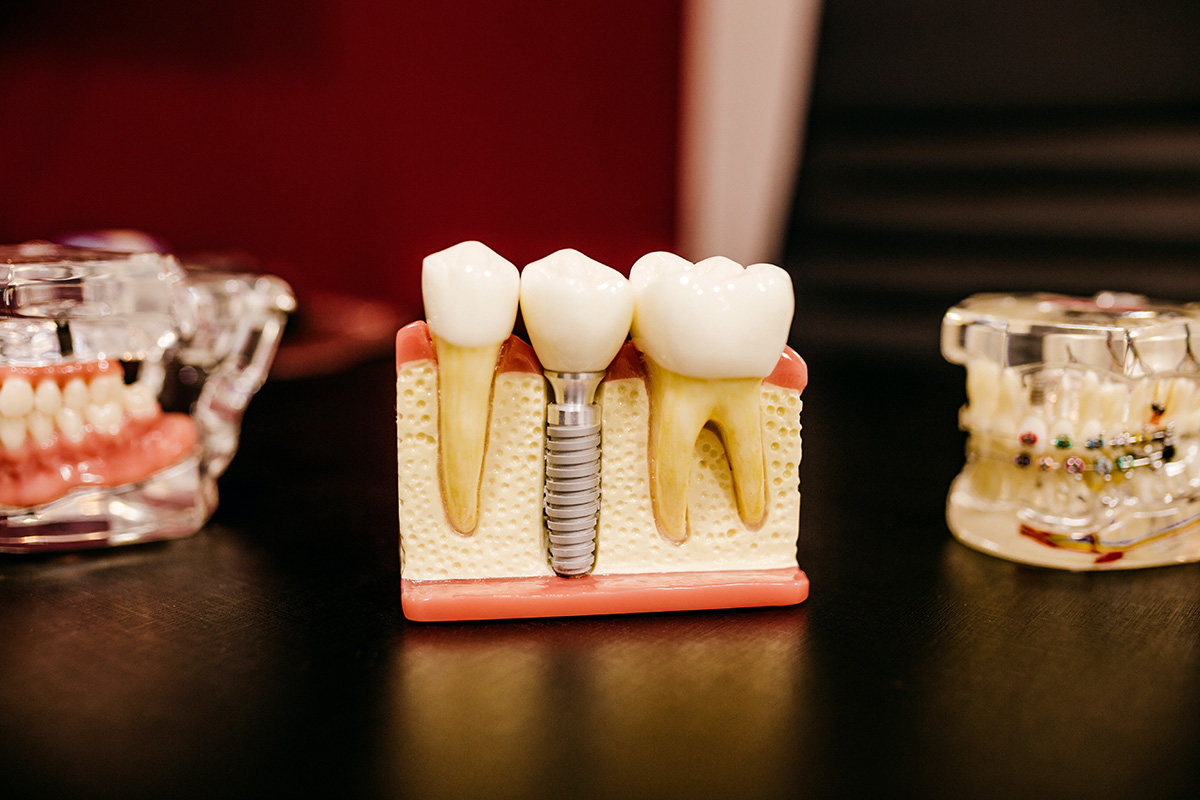 Dental implants, the solution to dentures How's To Do
