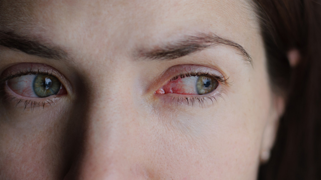 woman with conjunctivitis