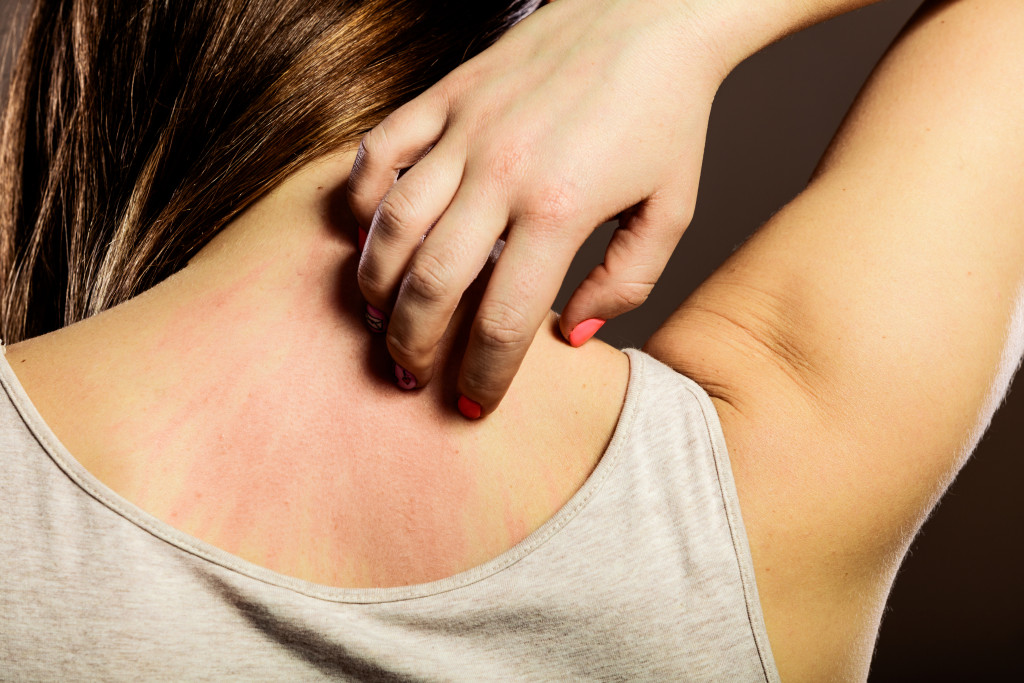 a woman with skin rash at the back